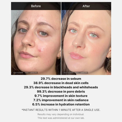 Medicube Red Acne Succinic Acid Peel | Peeling Serum 40g