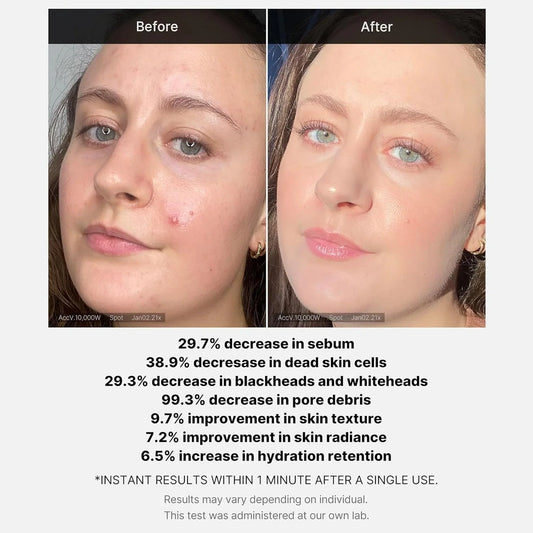 Medicube Red Acne Succinic Acid Peel | Peeling Serum 40g